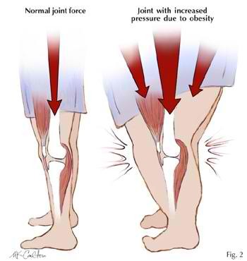 obesity knee pain