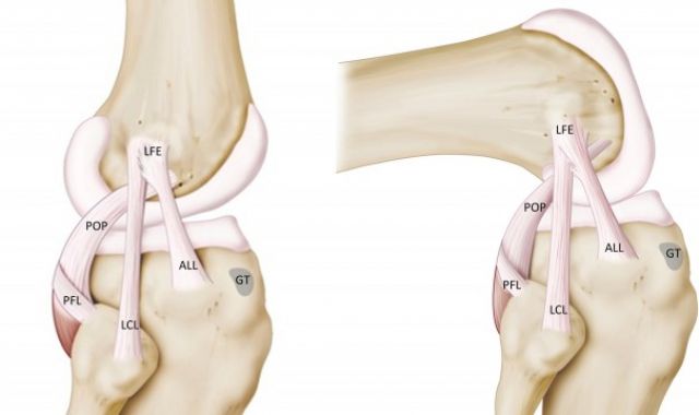 Antero-Lateral Ligament (ALL) Augmentation 