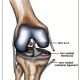 Go to ACL rupture and associated structural injuries of the knee