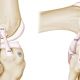 Go to Antero-Lateral Ligament (ALL) Augmentation