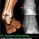 Early Mobilisation reduces the risk of complications in Ankle Fracture Fixation Surgery