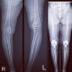 Go to Bilateral (2) Hip and Knee Replacements