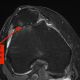 Go to Patella-Femoral Joint Arthritis