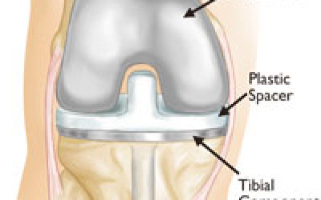 How old is too Young for Hip and knee arthroplasty