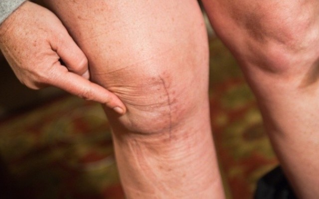 What Can Go Wrong with Knee Replacement????