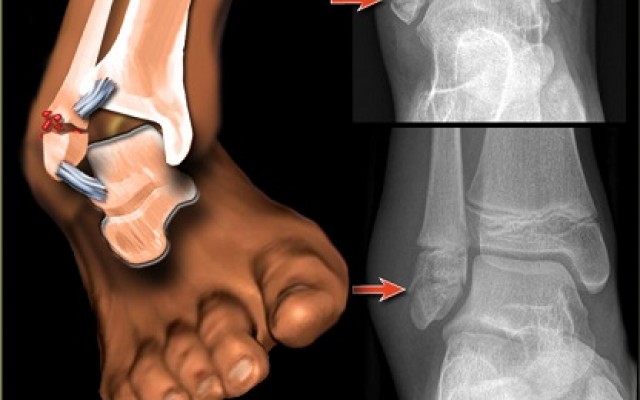 Early Mobilisation reduces the risk of complications in Ankle Fracture Fixation Surgery