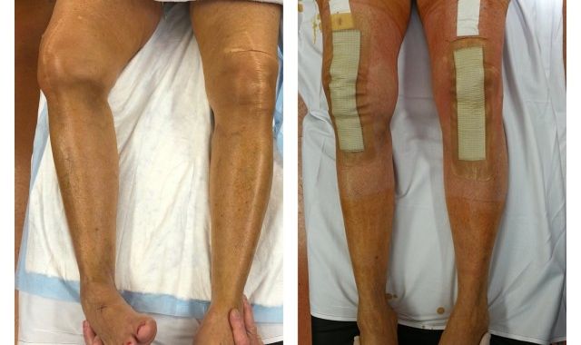 Navigated Medial Epicondylar Slide Osteotomy (TKR)