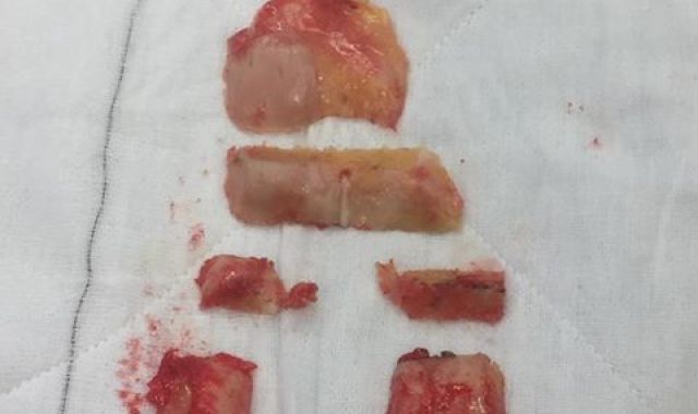 Total Knee Replacement vs Resurfacing