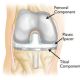 Go to How old is too Young for Hip and knee arthroplasty