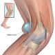 Go to Baker's Cyst of The Knee